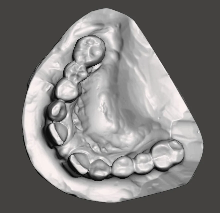Modelo tridimensional de molde dental digitalizado com Revopoint MINI 2 Modelo tridimensional de molde dental digitalizado com Revopoint MINI 2